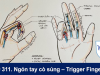Ngón Tay Cò Súng – Nguy Cơ Tiềm Ẩn Với Đôi Tay Của Bạn