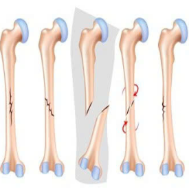 Điều Trị Gãy Xương
