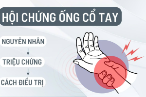 Hội chứng ống cổ tay : triệu chứng, nguyên nhân và cách điều trị hiệu quả 