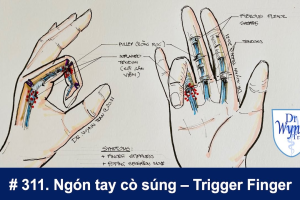 Ngón Tay Cò Súng – Nguy Cơ Tiềm Ẩn Với Đôi Tay Của Bạn