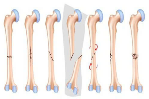 Điều Trị Gãy Xương