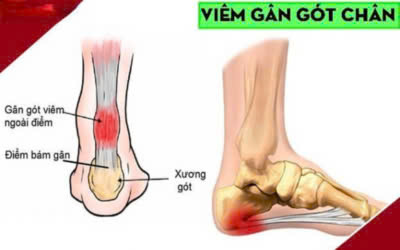 Viêm gân (viêm gân gót Achilles, viêm gân khuỷu tay)