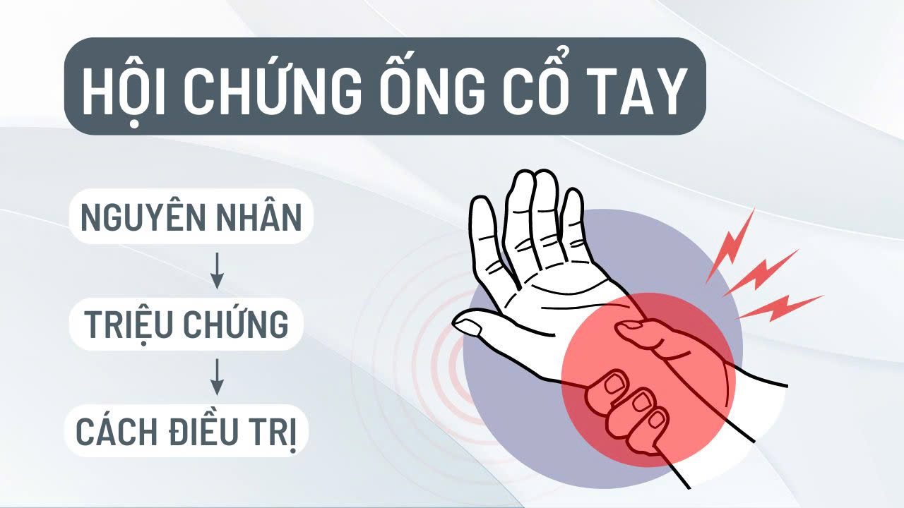 Hội chứng ống cổ tay không điều trị có thể gây teo cơ, yếu tay vĩnh viễn