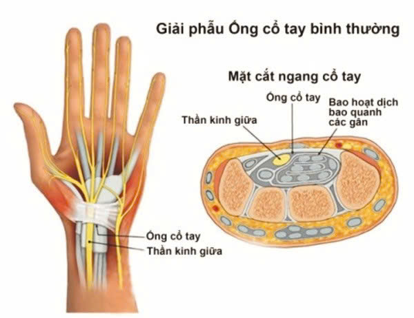 Phẫu thuật nội soi ống cổ tay giúp giải phóng chèn ép thần kinh