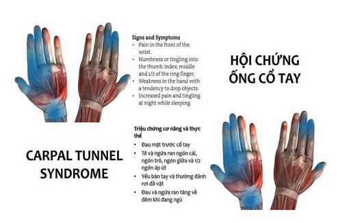 Tê tay, ngứa ran ngón cái, ngón trỏ và ngón giữa do hội chứng ống cổ tay