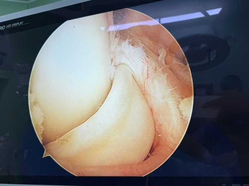 Tổn thương rách sụn chêm dạng quai xách