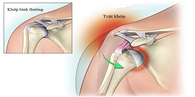 Trật khớp ở vai