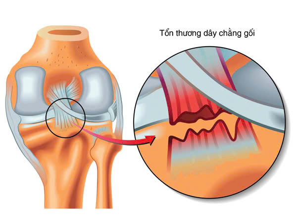 Rách dây chằng trước gối