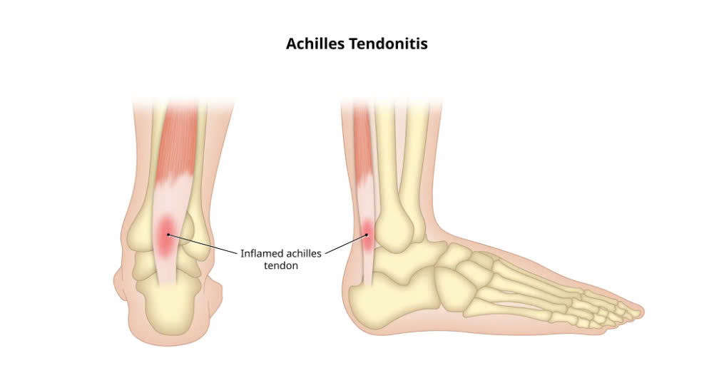 Viêm của gân thường gặp ở gân gót Achilles