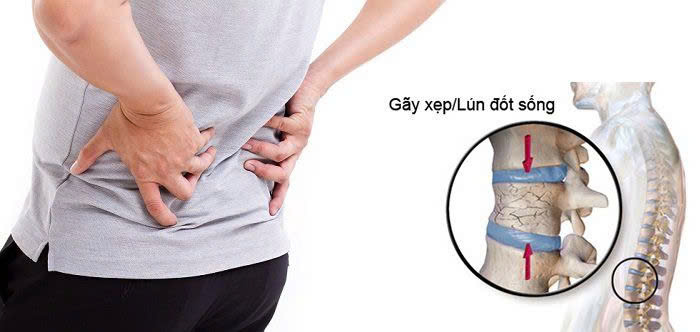 Gãy xương cột sống